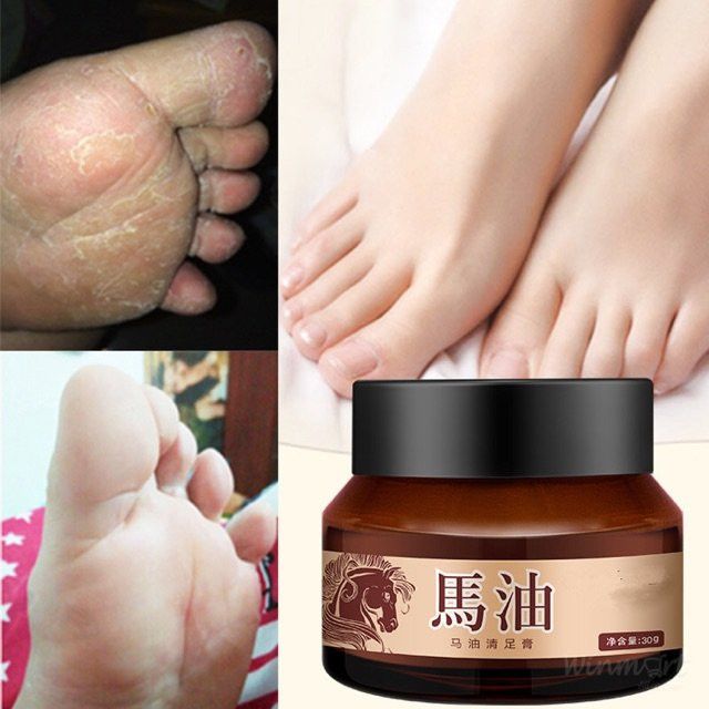 KEM CAO NGỰA TRỊ NỨT NẺ CHÂN TAY - SET 3 HỦ 